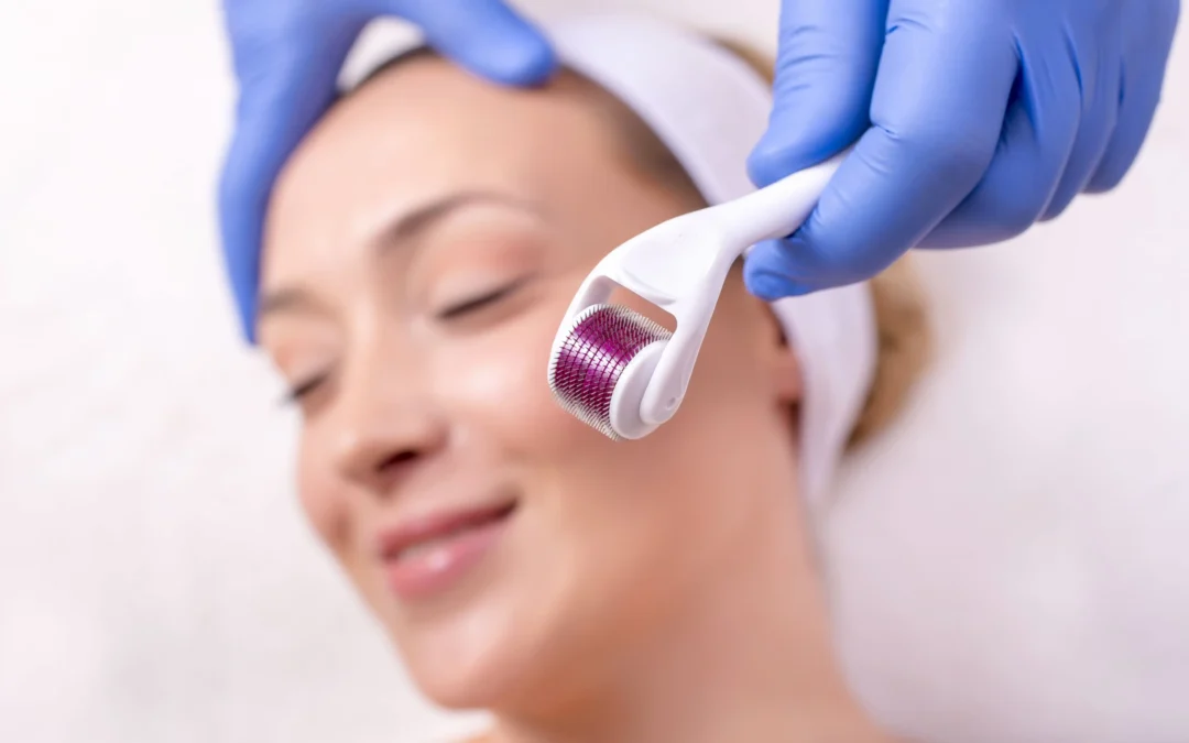 Nuevo Tratamiento Revolucionario Rejuvenece la Piel: Terapia de Microagujas con Factor de Crecimiento
