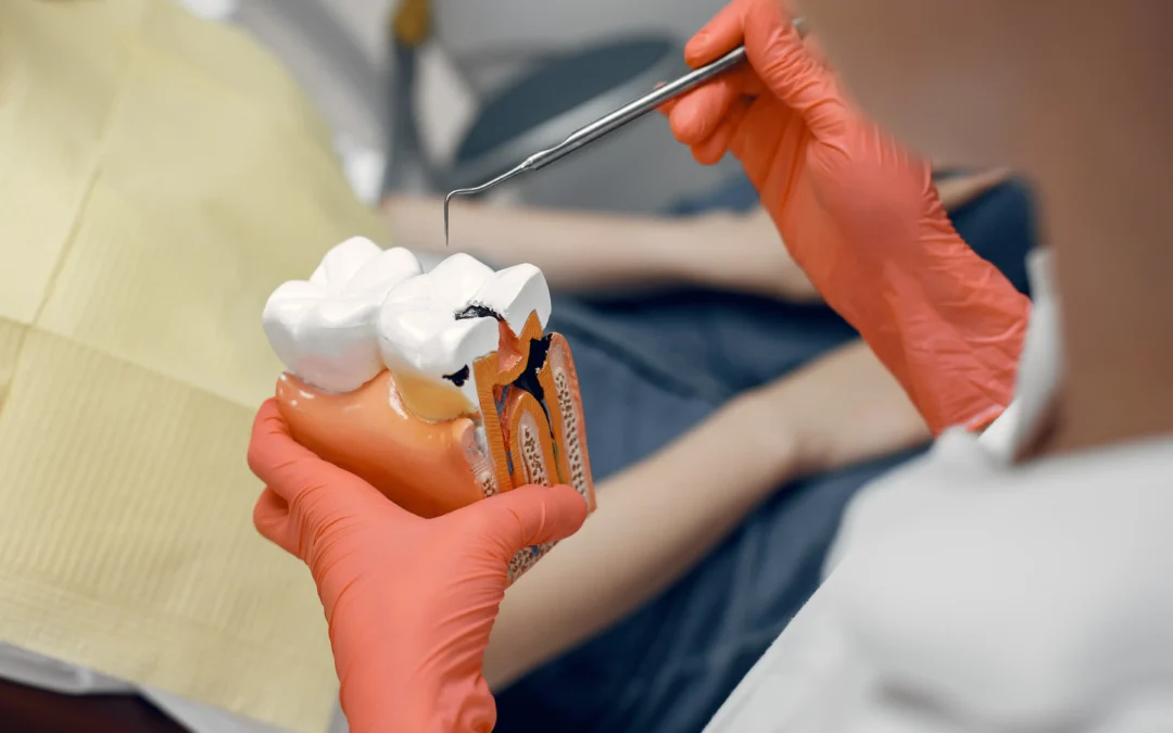Avances en la Investigación Dental: Nuevo Método Revoluciona el Tratamiento de Caries